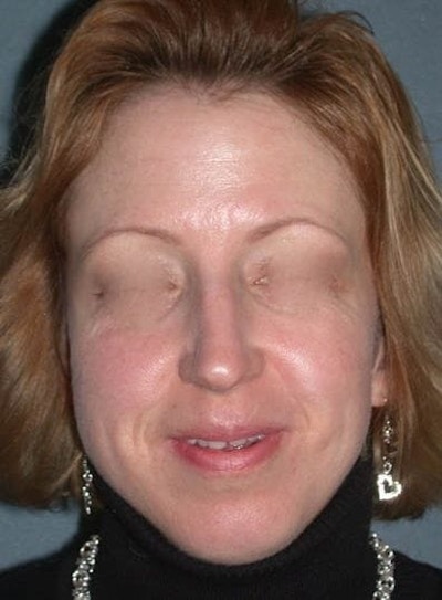 Rhinoplasty Before & After Gallery - Patient 155267 - Image 1