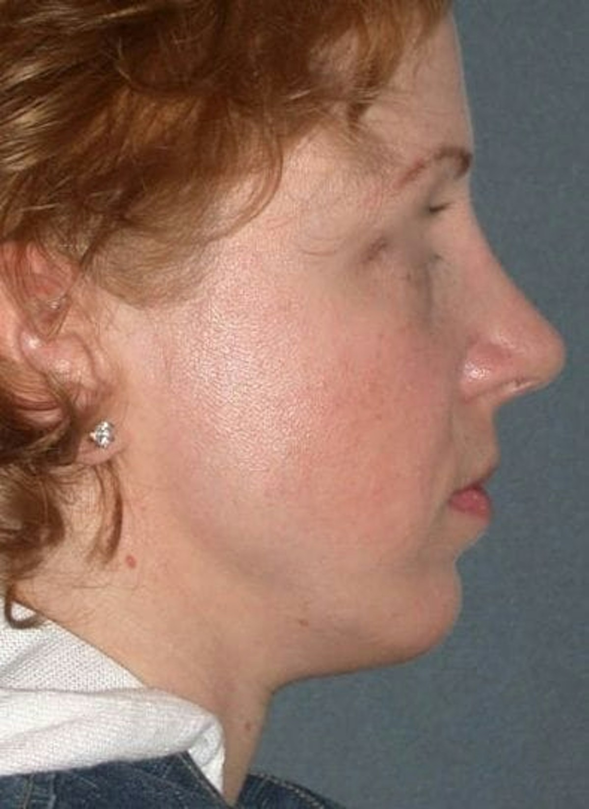 Rhinoplasty Before & After Gallery - Patient 155267 - Image 6