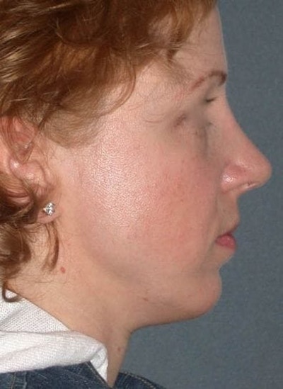 Rhinoplasty Before & After Gallery - Patient 155267 - Image 2