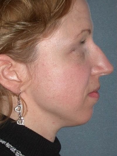 Rhinoplasty Before & After Gallery - Patient 155267 - Image 1