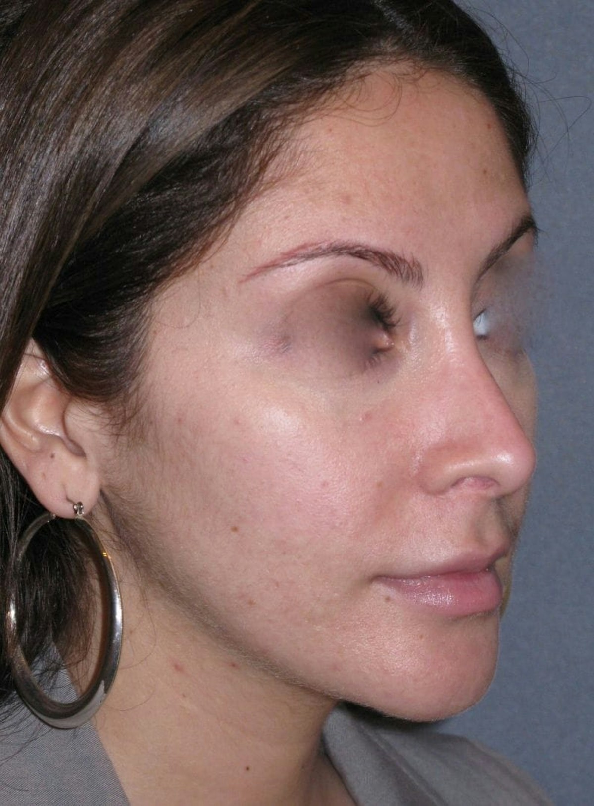 Rhinoplasty Before & After Gallery - Patient 264497 - Image 4