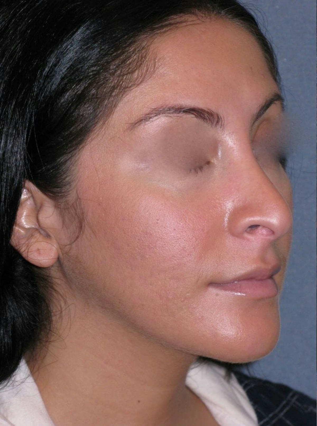 Rhinoplasty Before & After Gallery - Patient 264497 - Image 3