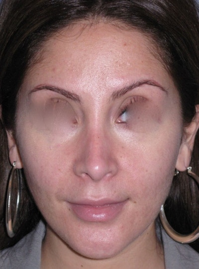 Rhinoplasty Before & After Gallery - Patient 264497 - Image 2