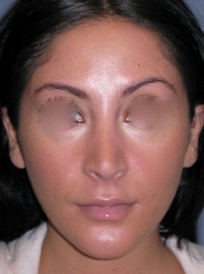 Rhinoplasty Before & After Gallery - Patient 264497 - Image 1