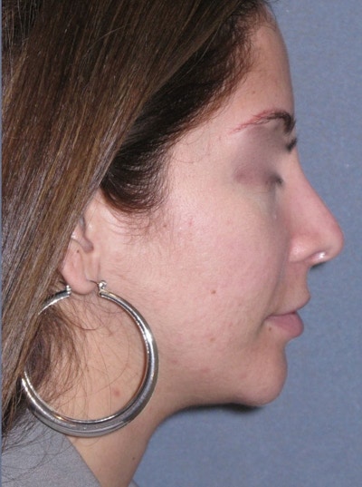 Rhinoplasty Before & After Gallery - Patient 264497 - Image 2