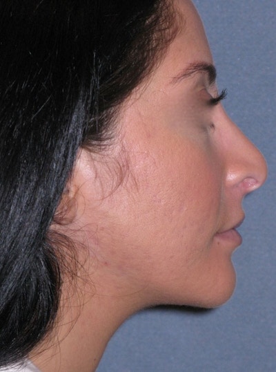 Rhinoplasty Before & After Gallery - Patient 264497 - Image 1