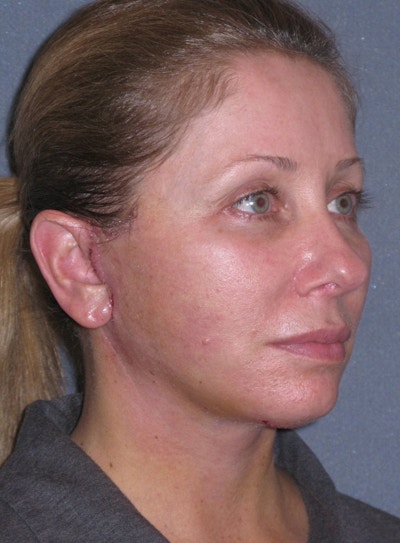 Lower Face/Neck Lift Over Time Before & After Gallery - Patient 182788 - Image 2