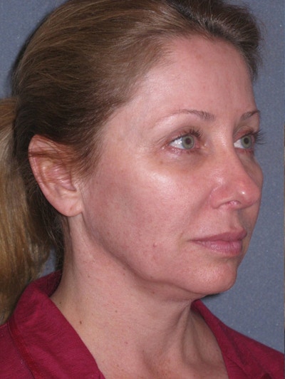 Lower Face/Neck Lift Over Time Before & After Gallery - Patient 182788 - Image 1