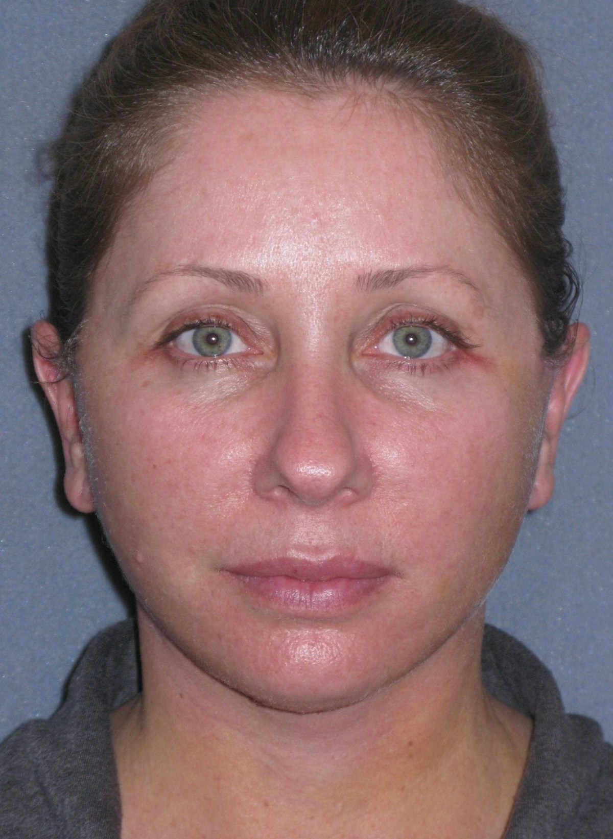Lower Face/Neck Lift Over Time Before & After Gallery - Patient 182788 - Image 4