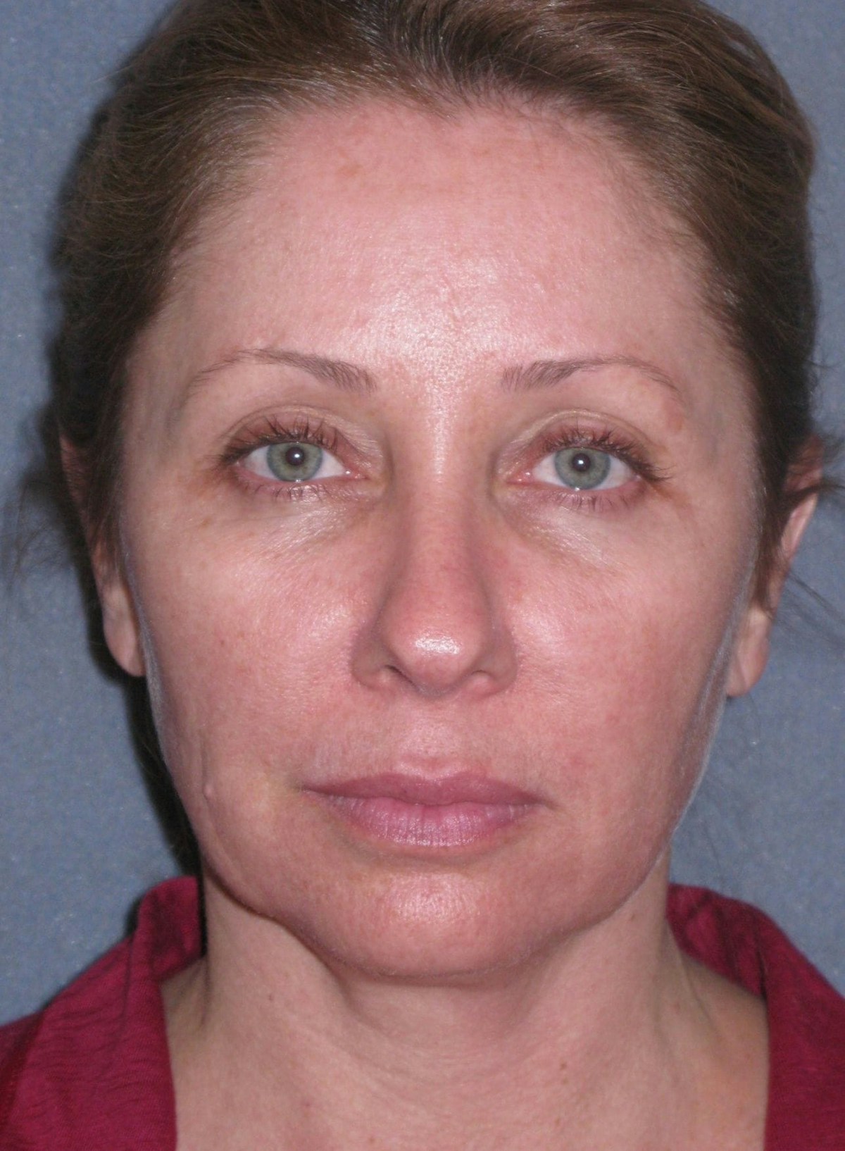 Lower Face/Neck Lift Over Time Before & After Gallery - Patient 182788 - Image 3