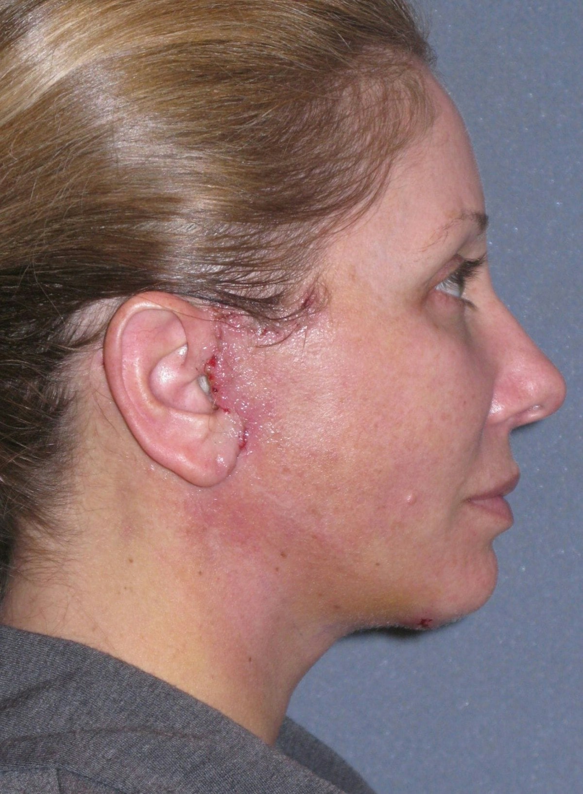 Lower Face/Neck Lift Over Time Before & After Gallery - Patient 182788 - Image 6