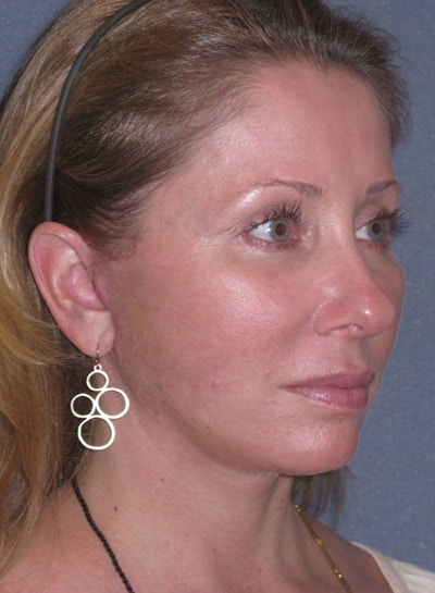 Lower Face/Neck Lift Over Time Before & After Gallery - Patient 296066 - Image 2