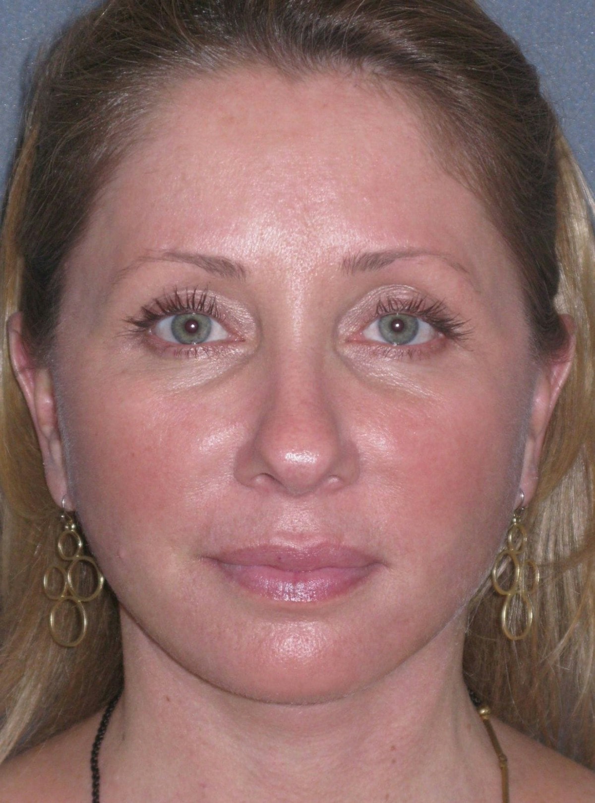 Lower Face/Neck Lift Over Time Before & After Gallery - Patient 296066 - Image 4