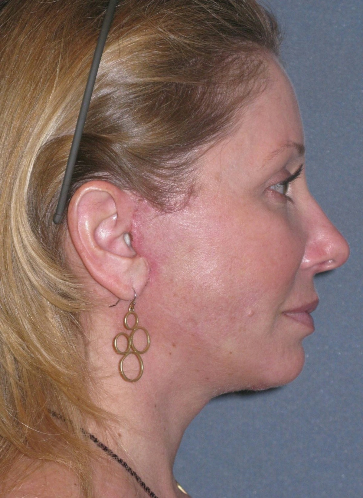 Lower Face/Neck Lift Over Time Before & After Gallery - Patient 296066 - Image 6