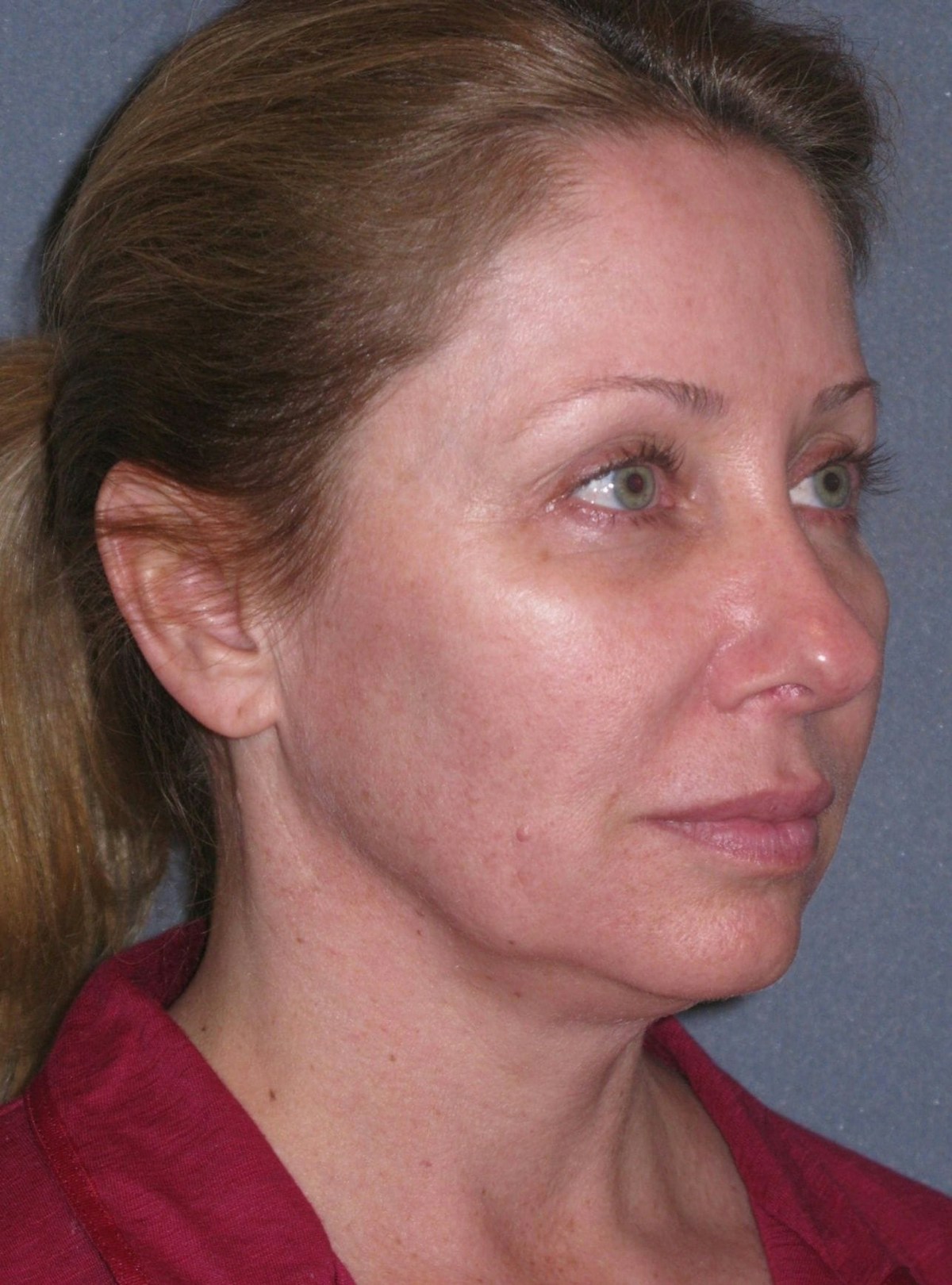Lower Face/Neck Lift Over Time Before & After Gallery - Patient 296066 - Image 1