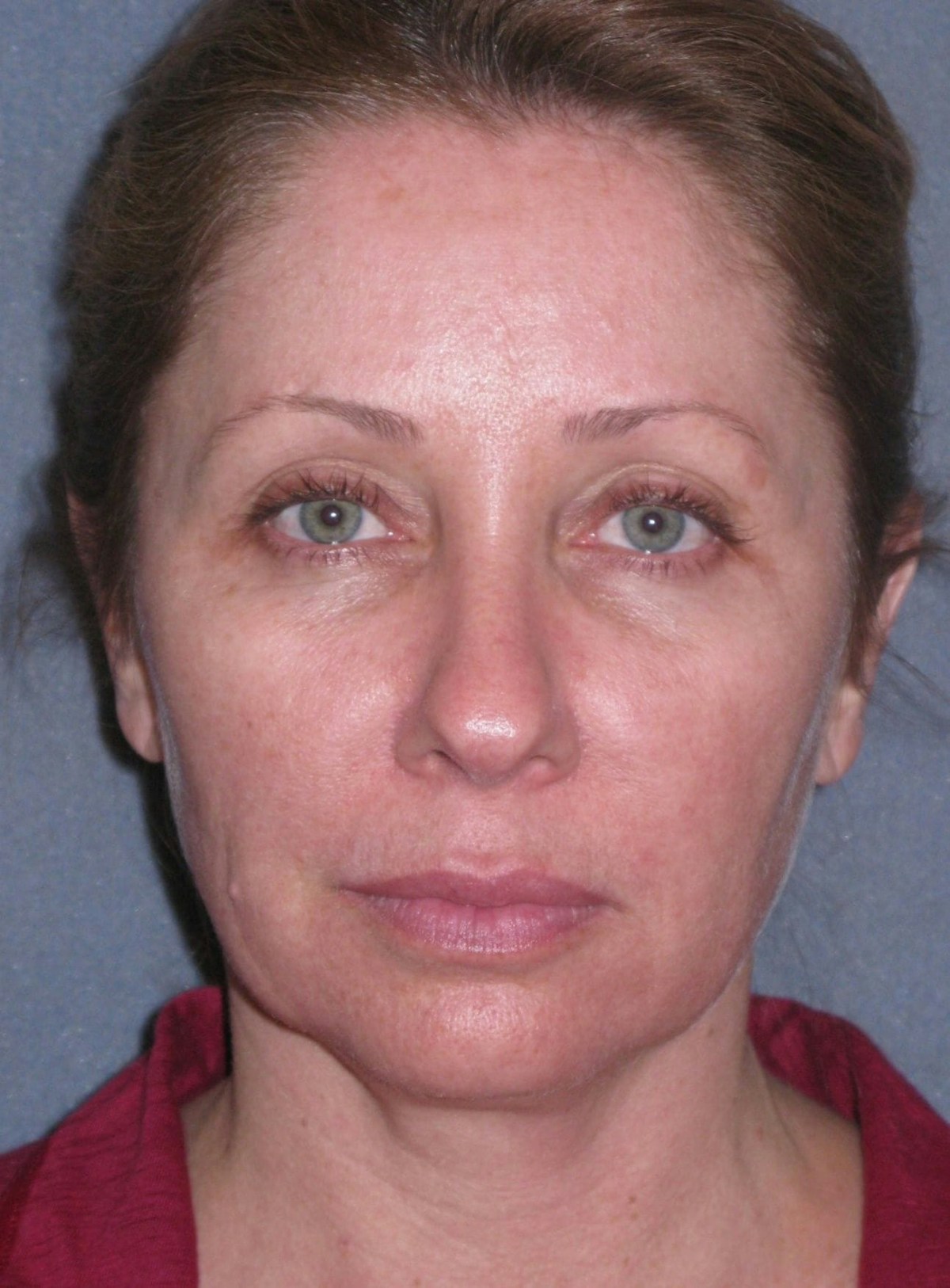 Lower Face/Neck Lift Over Time Before & After Gallery - Patient 296066 - Image 3