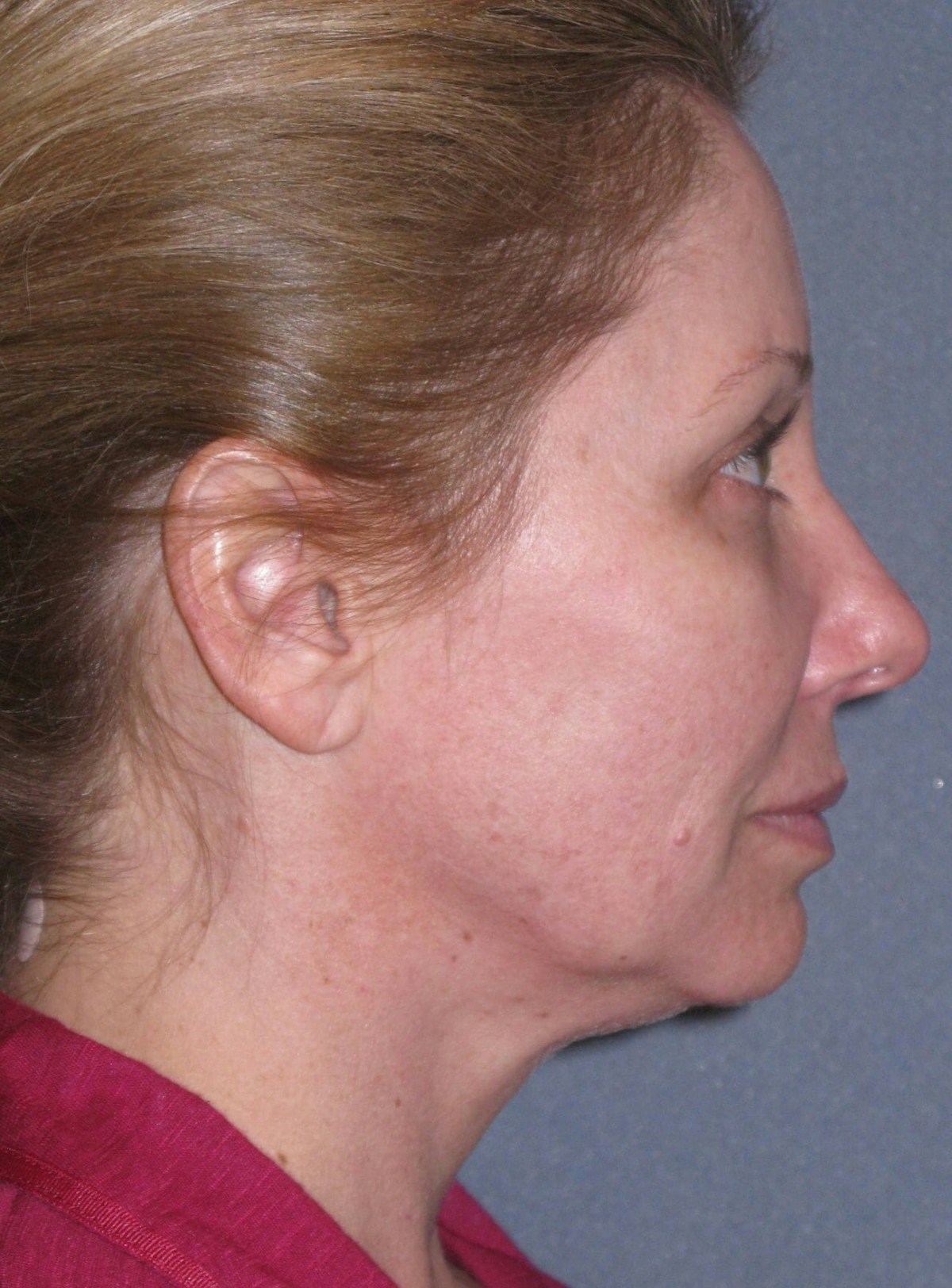 Lower Face/Neck Lift Over Time Before & After Gallery - Patient 296066 - Image 5