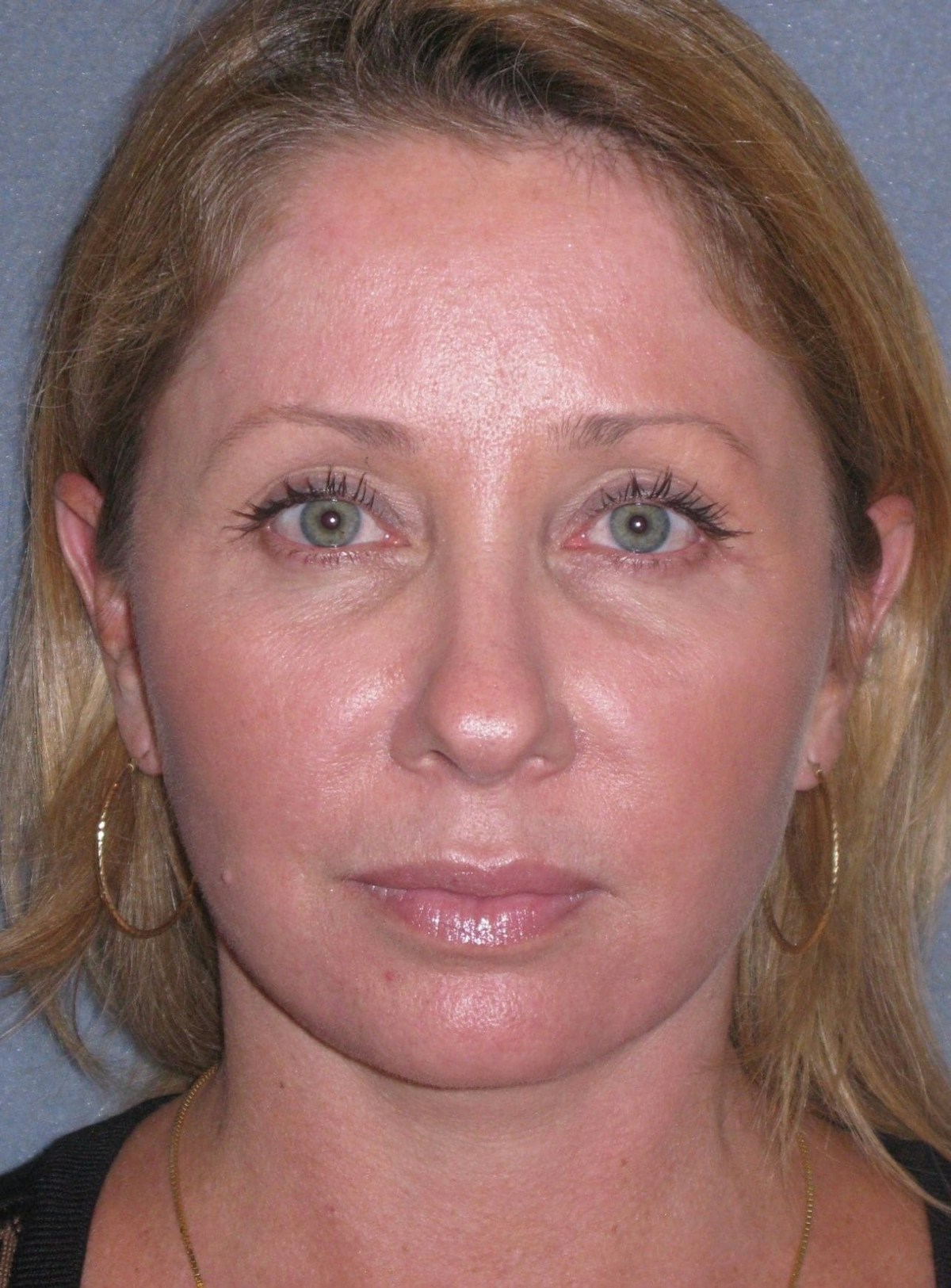 Lower Face/Neck Lift Over Time Before & After Gallery - Patient 342278 - Image 8