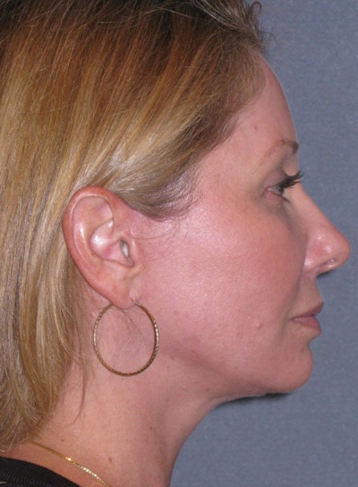 Lower Face/Neck Lift Over Time Before & After Gallery - Patient 342278 - Image 2