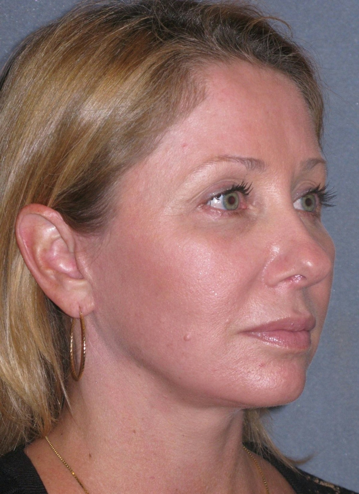 Lower Face/Neck Lift Over Time Before & After Gallery - Patient 342278 - Image 6