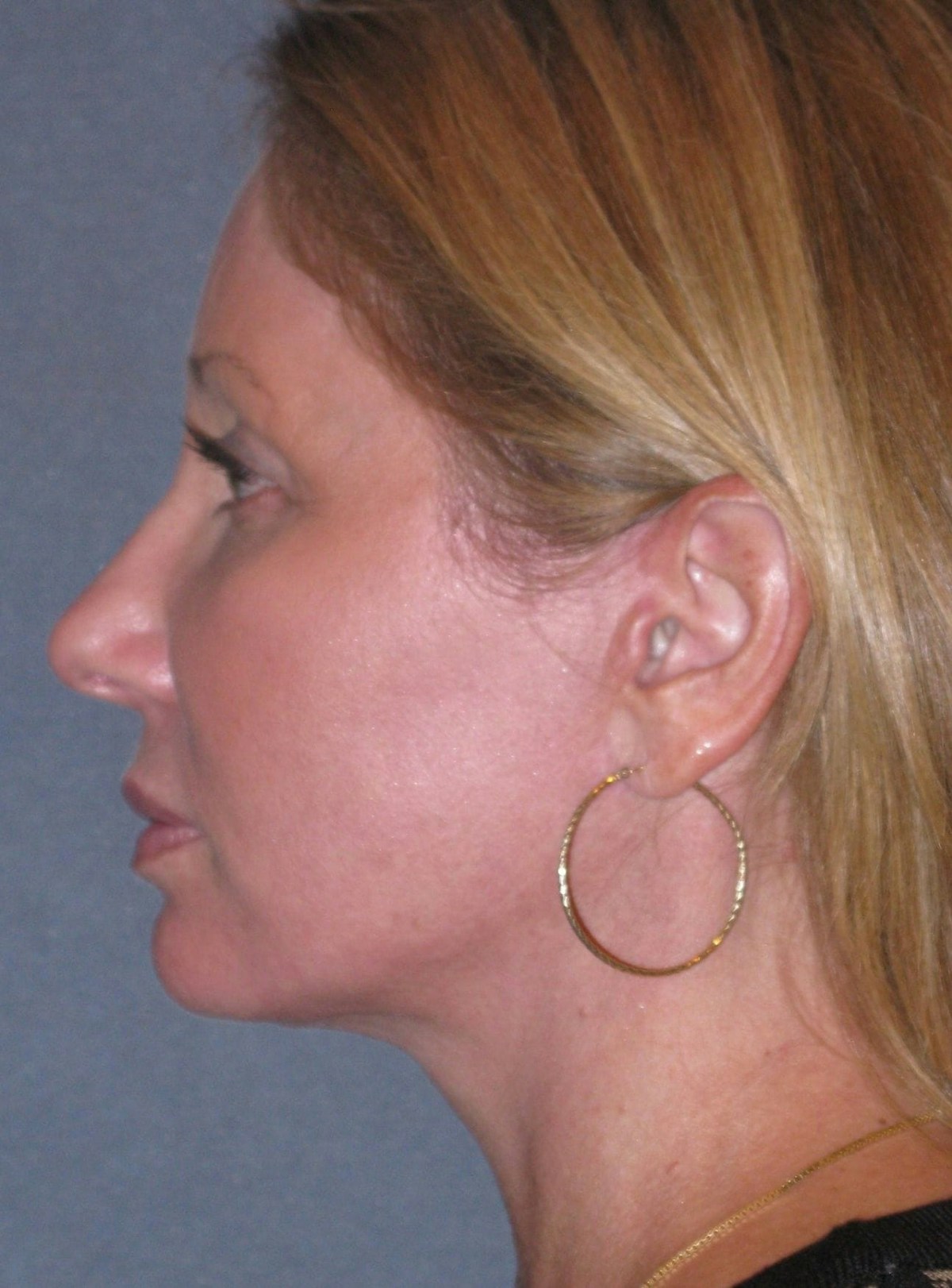 Lower Face/Neck Lift Over Time Before & After Gallery - Patient 342278 - Image 4