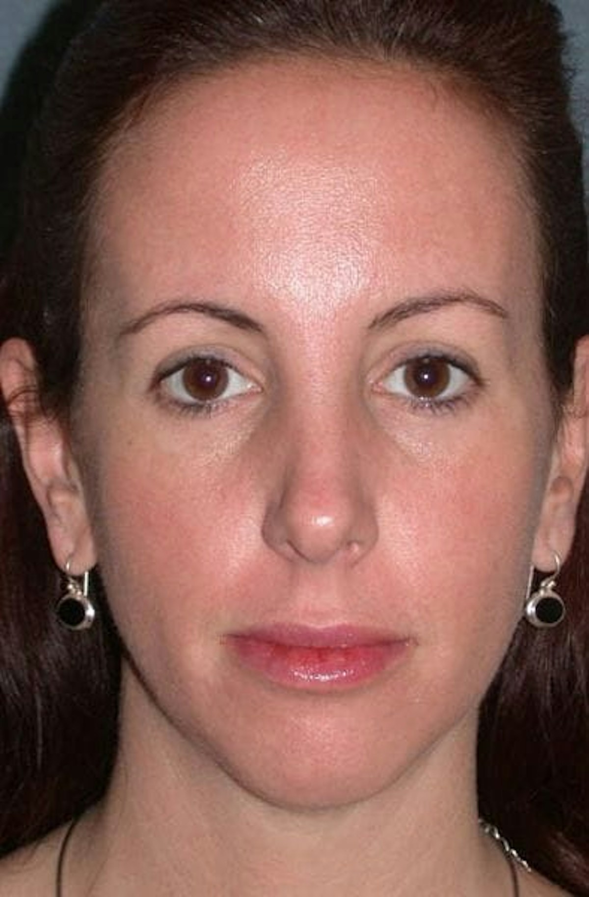 Fraxel Restore Before & After Gallery - Patient 339461 - Image 2