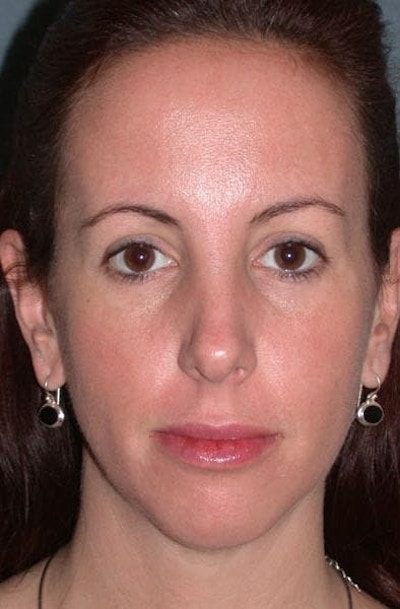 Fraxel Restore Before & After Gallery - Patient 339461 - Image 2