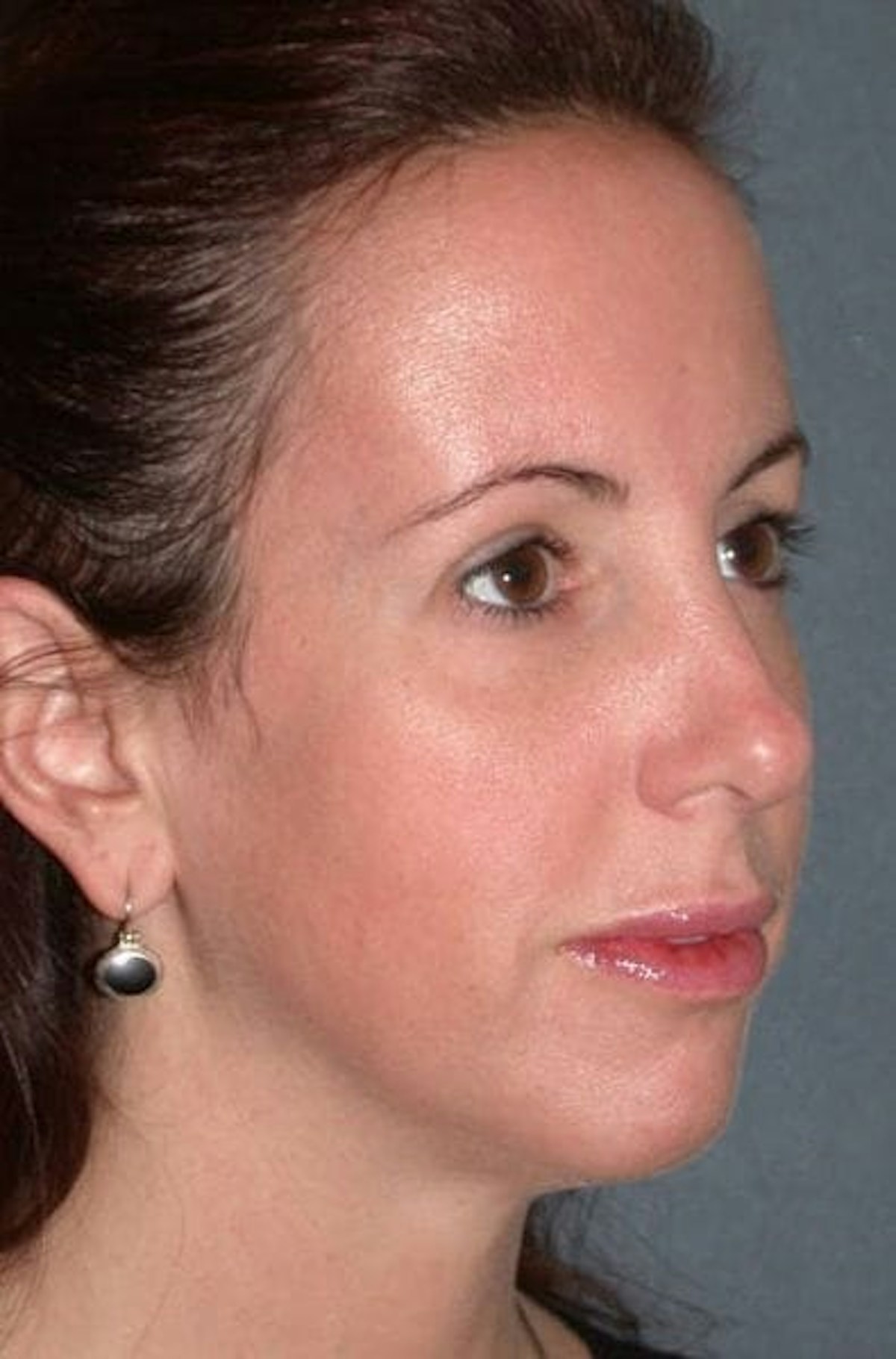 Fraxel Restore Before & After Gallery - Patient 339461 - Image 4