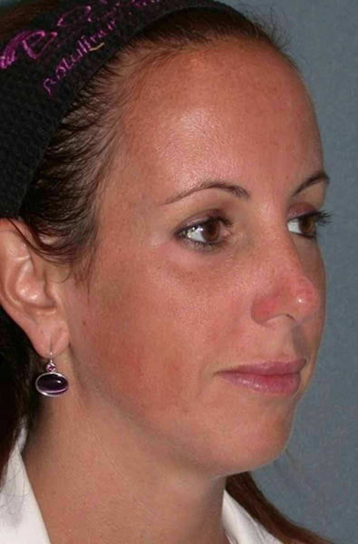 Fraxel Restore Before & After Gallery - Patient 339461 - Image 3