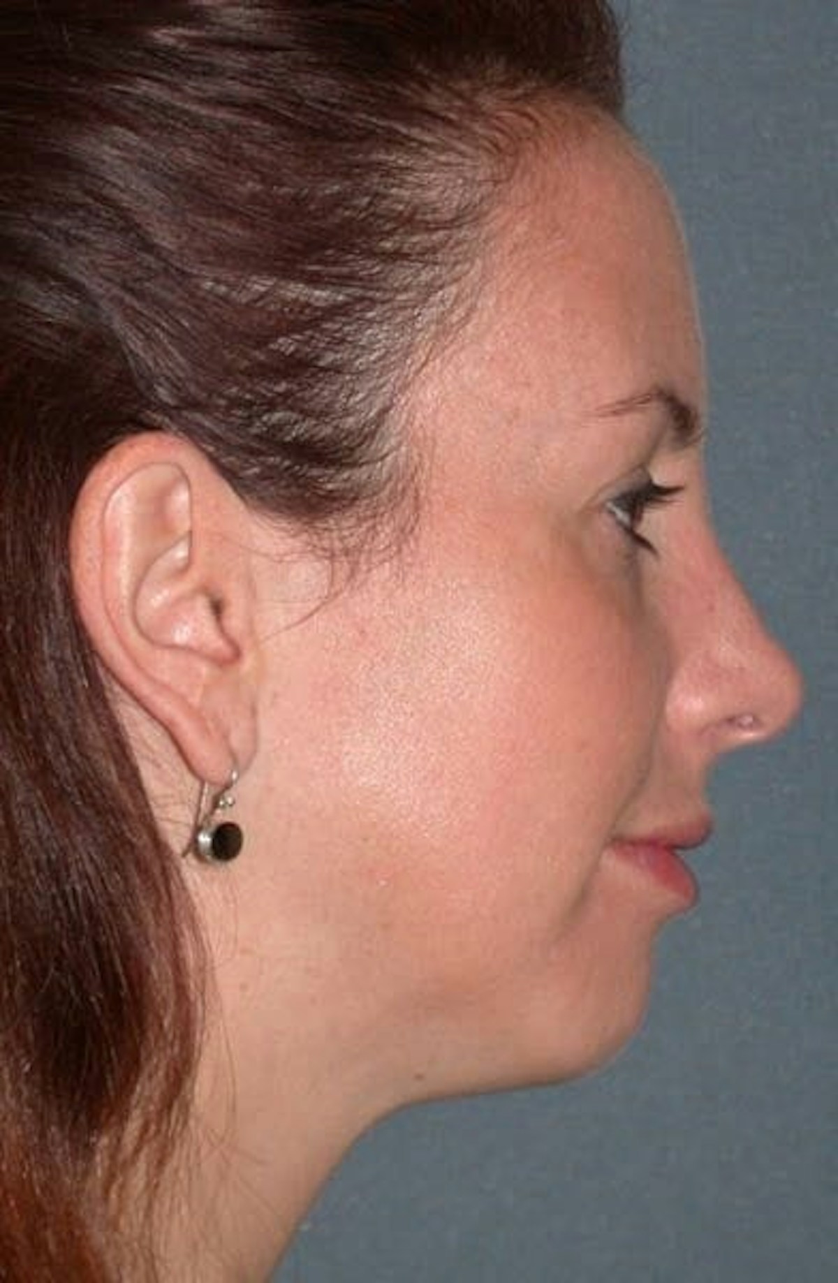Fraxel Restore Before & After Gallery - Patient 339461 - Image 6
