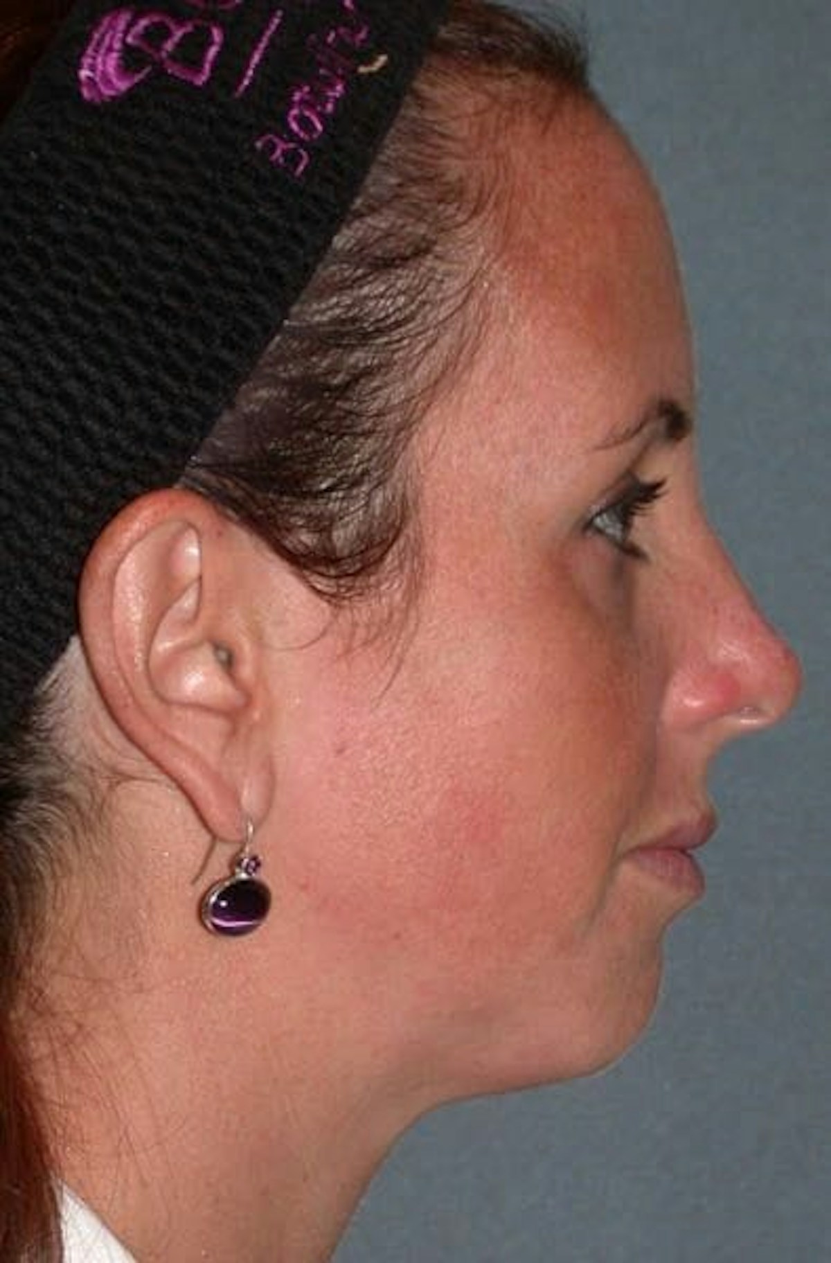 Fraxel Restore Before & After Gallery - Patient 339461 - Image 5
