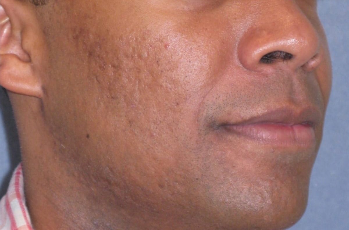 Fraxel Restore Acne Scarring Before & After Gallery - Patient 274205 - Image 2