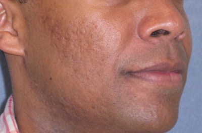 Fraxel Restore Acne Scarring Before & After Gallery - Patient 274205 - Image 2
