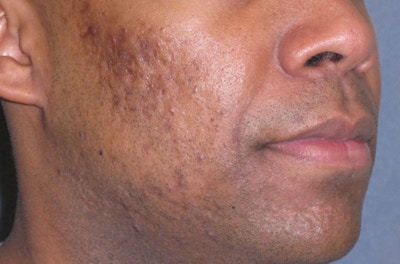 Fraxel Restore Acne Scarring Before & After Gallery - Patient 274205 - Image 1