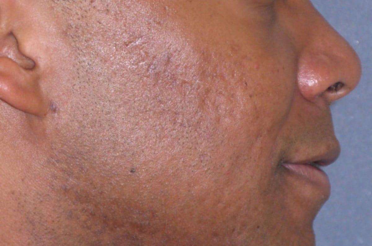 Fraxel Restore Acne Scarring Before & After Gallery - Patient 274205 - Image 4