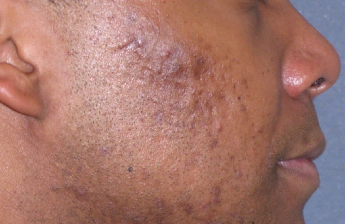 Fraxel Restore Acne Scarring Before & After Gallery - Patient 274205 - Image 3