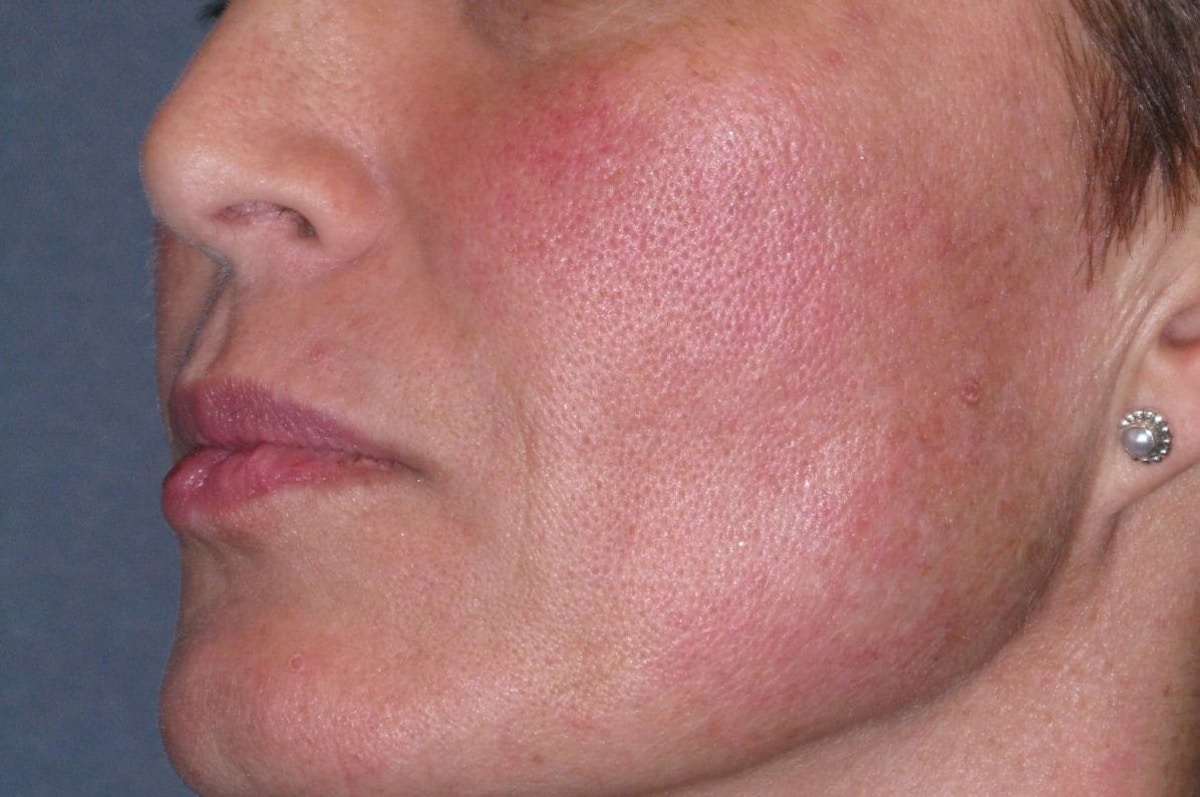 Juvéderm - Laugh Lines Before & After Gallery - Patient 222205 - Image 4