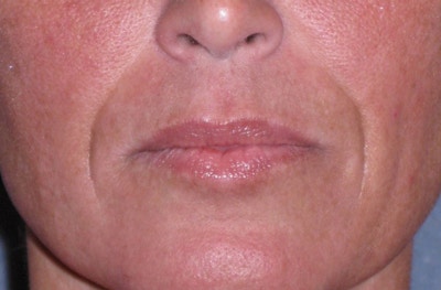 Juvéderm - Laugh Lines Before & After Gallery - Patient 222205 - Image 1