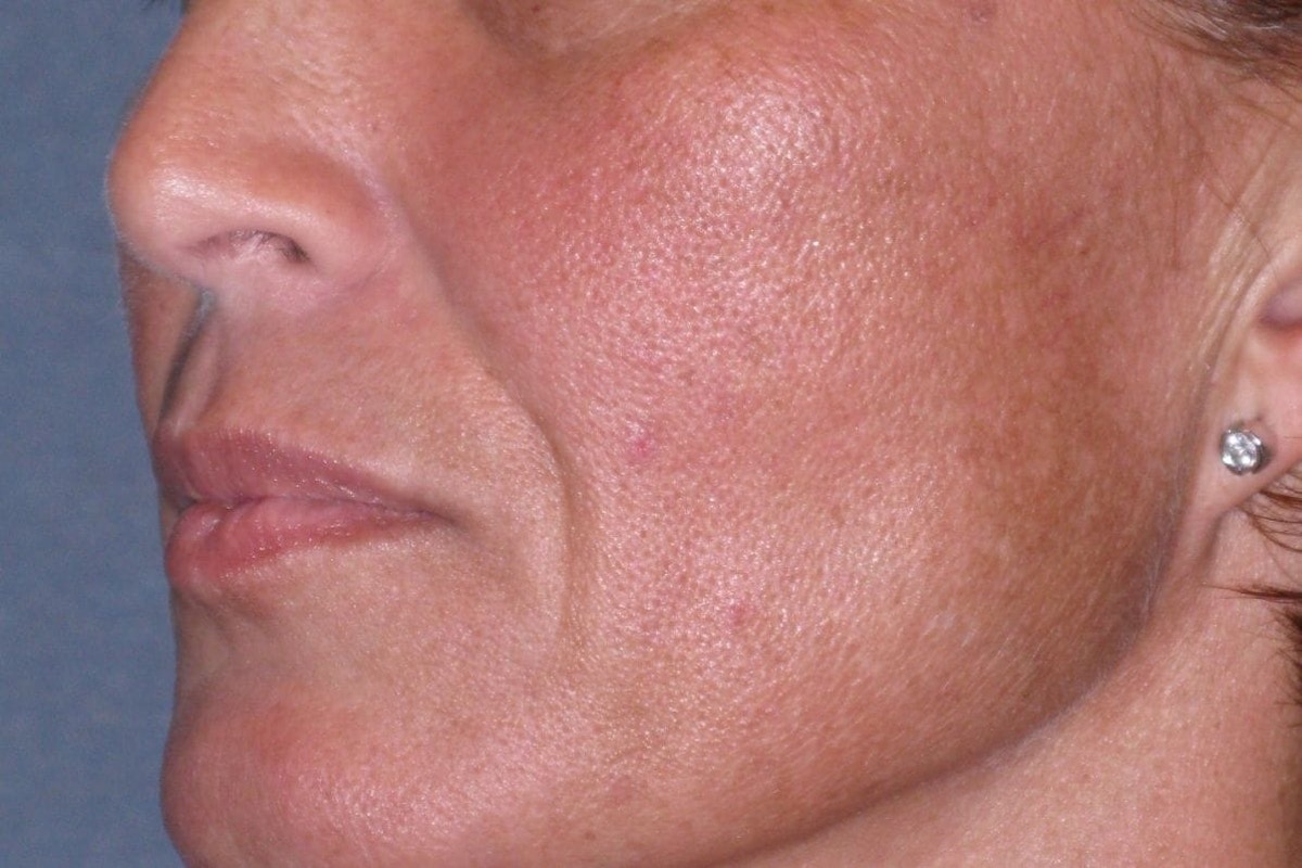 Juvéderm - Laugh Lines Before & After Gallery - Patient 222205 - Image 3