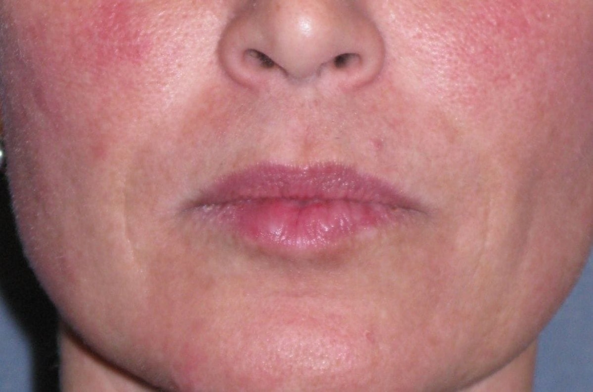 Juvéderm - Laugh Lines Before & After Gallery - Patient 222205 - Image 2