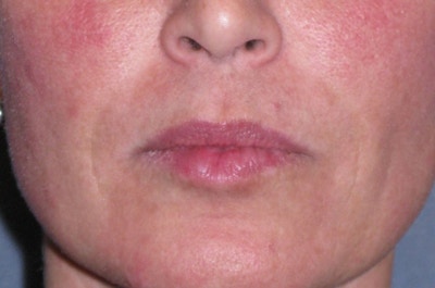 Juvéderm - Laugh Lines Before & After Gallery - Patient 222205 - Image 2