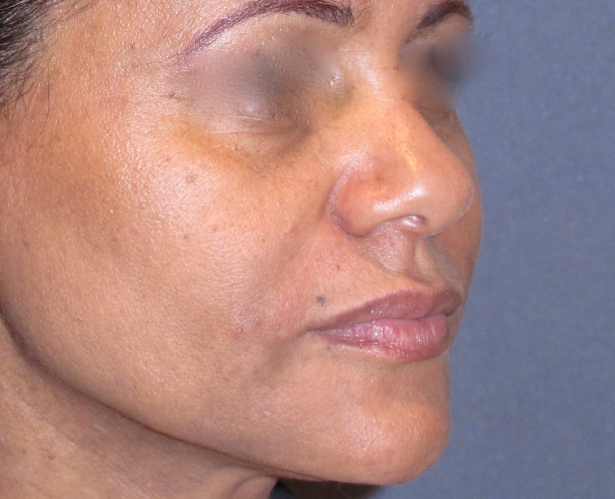 Juvéderm - Laugh Lines Before & After Gallery - Patient 373384 - Image 1