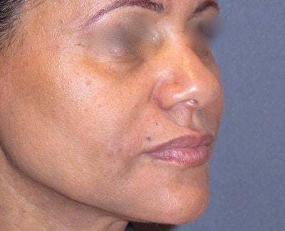 Juvéderm - Laugh Lines Before & After Gallery - Patient 373384 - Image 1