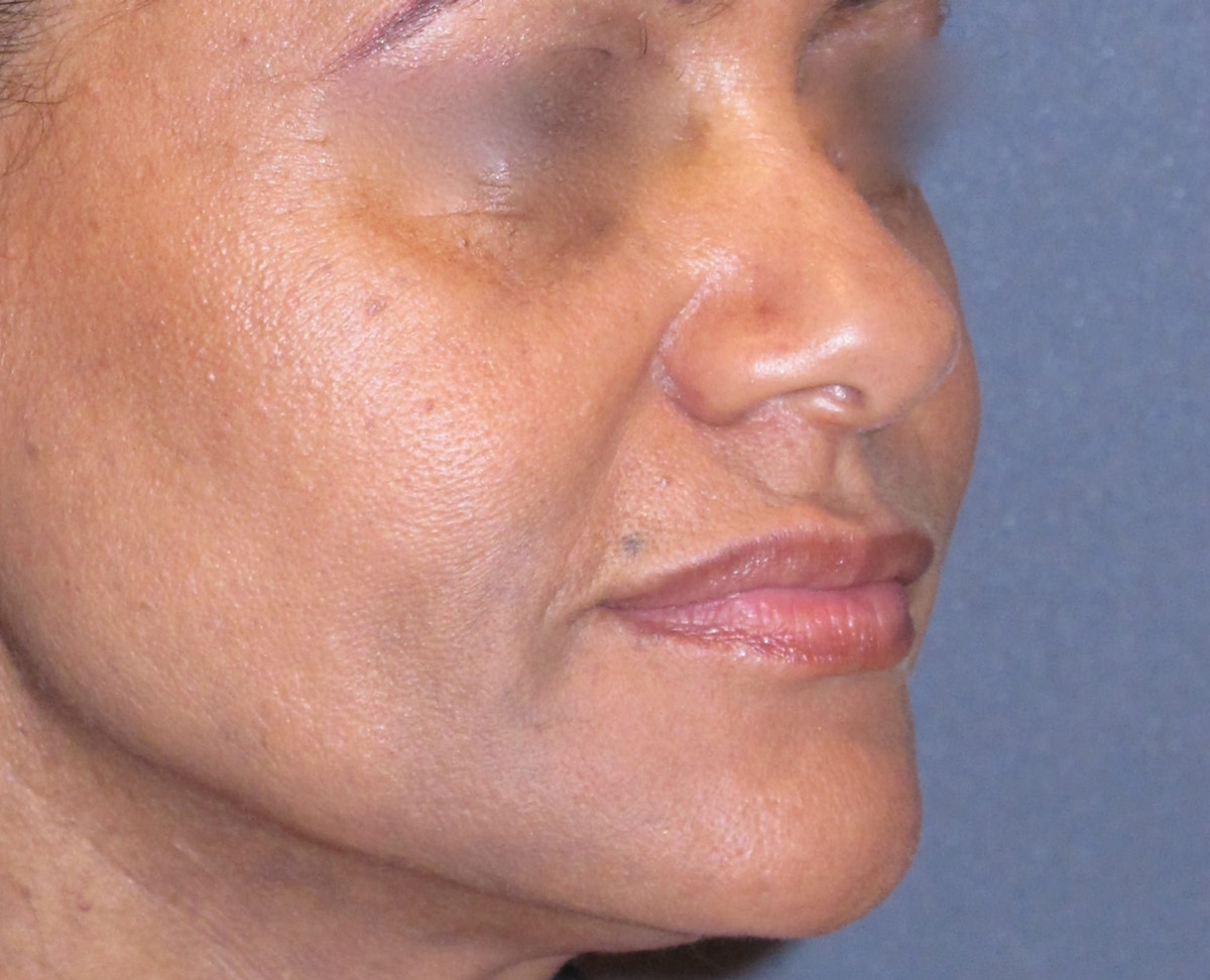 Juvéderm - Laugh Lines Before & After Gallery - Patient 373384 - Image 2