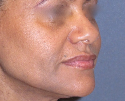 Juvéderm - Laugh Lines Before & After Gallery - Patient 373384 - Image 2