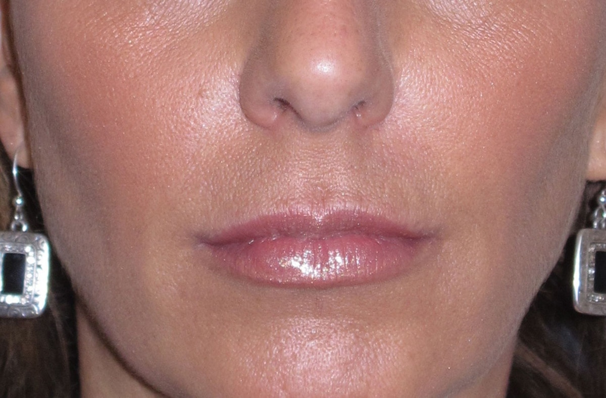 Juvéderm - Lips Before & After Gallery - Patient 690688 - Image 2