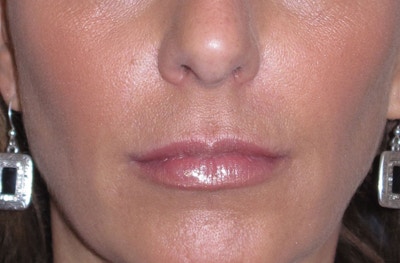 Juvéderm - Lips Before & After Gallery - Patient 690688 - Image 2