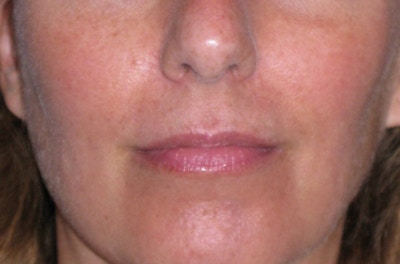 Juvéderm - Lips Before & After Gallery - Patient 690688 - Image 1