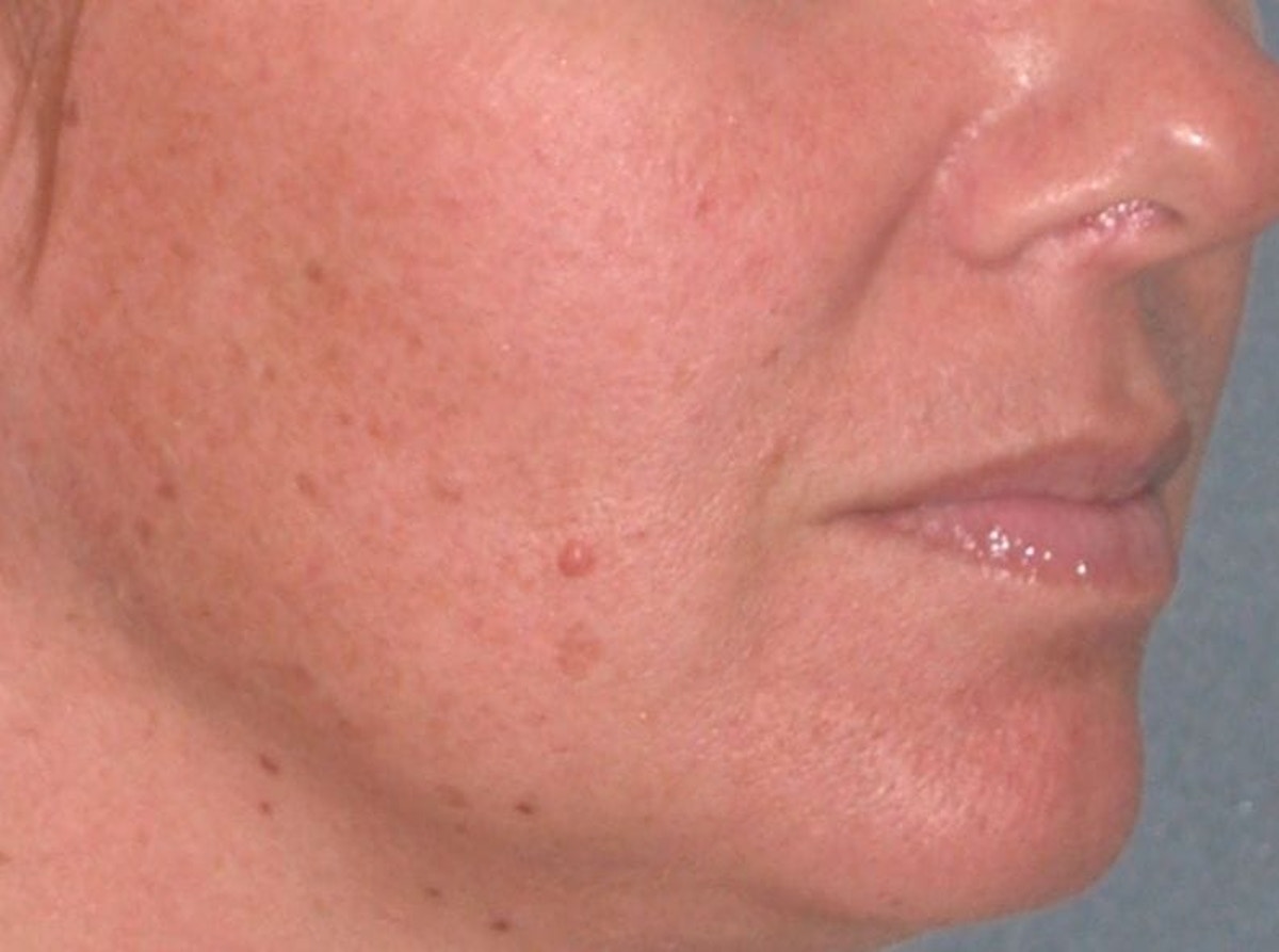 Juvéderm - Lips Before & After Gallery - Patient 326568 - Image 3