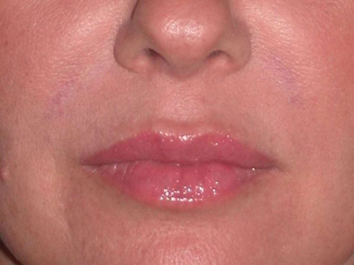 Juvéderm - Lips Before & After Gallery - Patient 326568 - Image 2